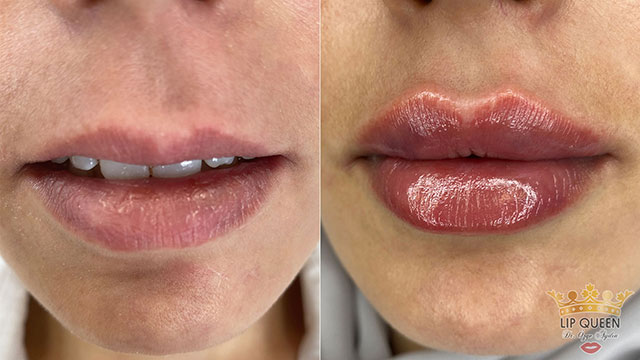 lip queen dudak dolgusu ankara doktor özge aydın