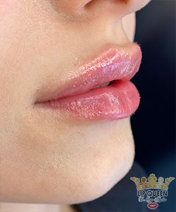 lip queen dudak dolgusu ankara doktor özge aydın